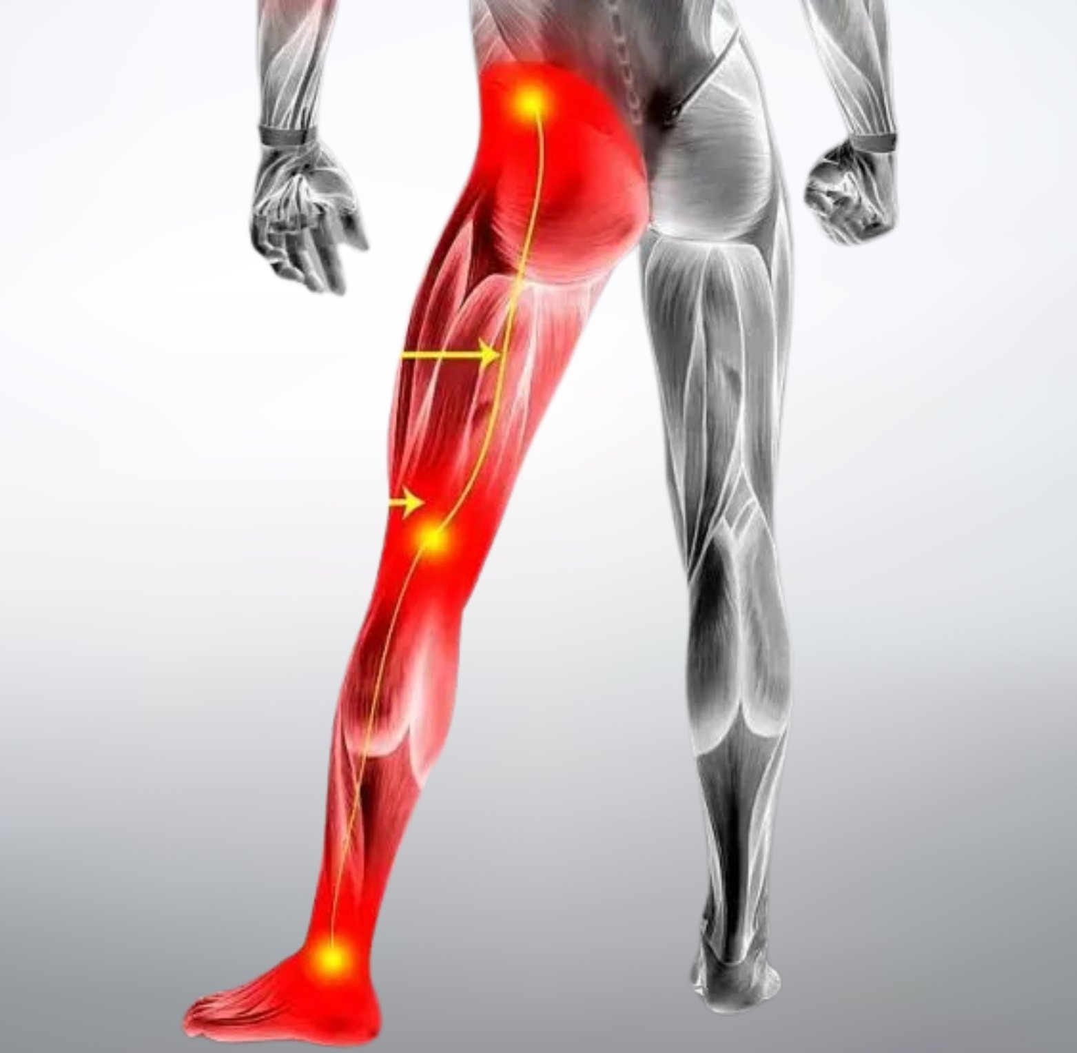 Sciatica